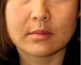 Feel Beautiful - Liposuction Lower Face 210 - Before Photo